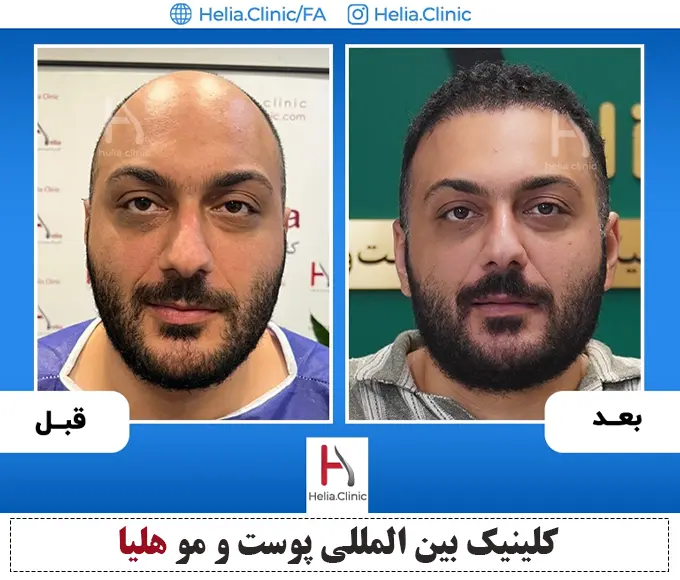 نتیجه کاشت مو به روش sut