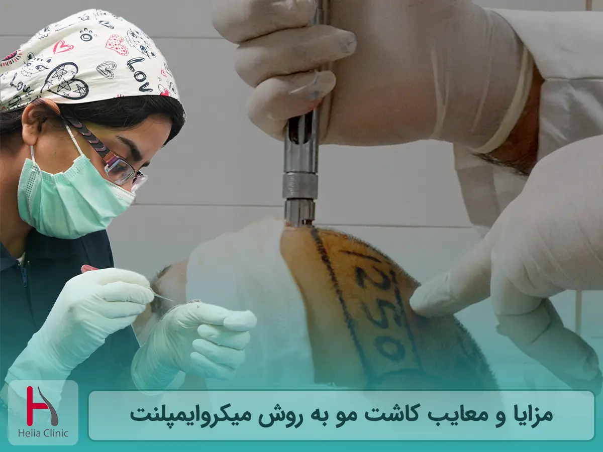 مزایا و معایب کاشت مو به روش میکروایمپلنت