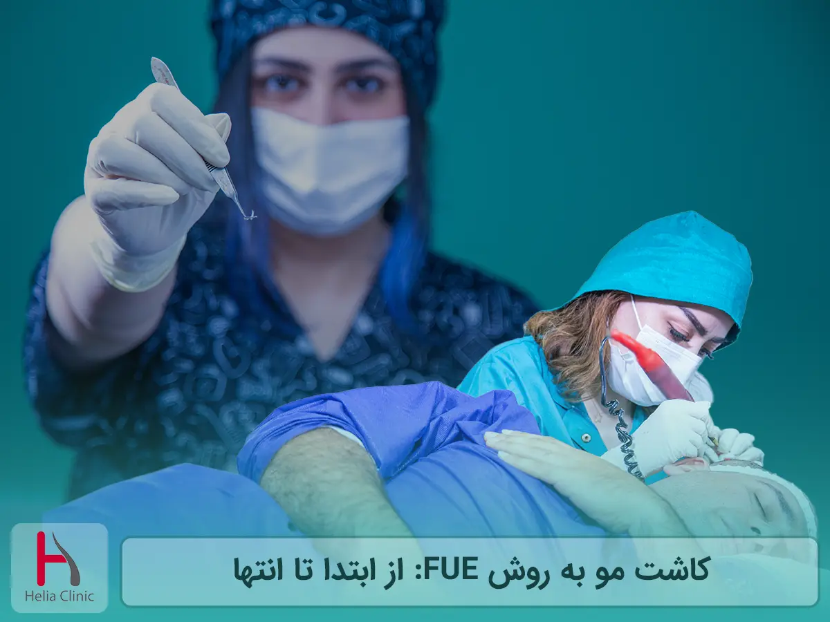 کاشت مو به روش FUE: از ابتدا تا انتها