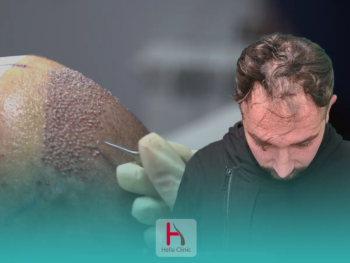 کاشت مو برای موهای کم پشت جلوی سر
