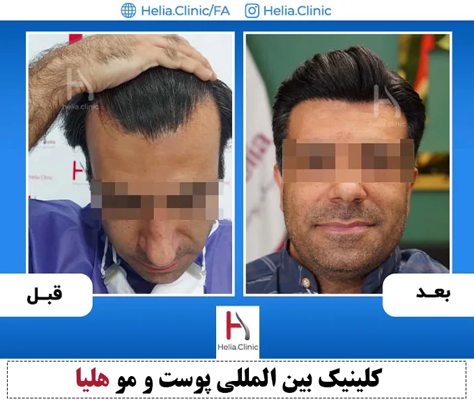 تجربه پیوند مو بدون جراحی و درد توسط دکتر خراسانی