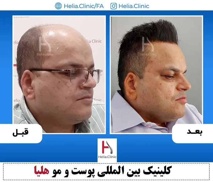 تصویر پیوند مو به شیوه میکرو fue
