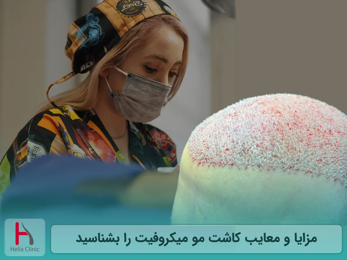 مزایا و معایب کاشت مو میکروفیت را بشناسید