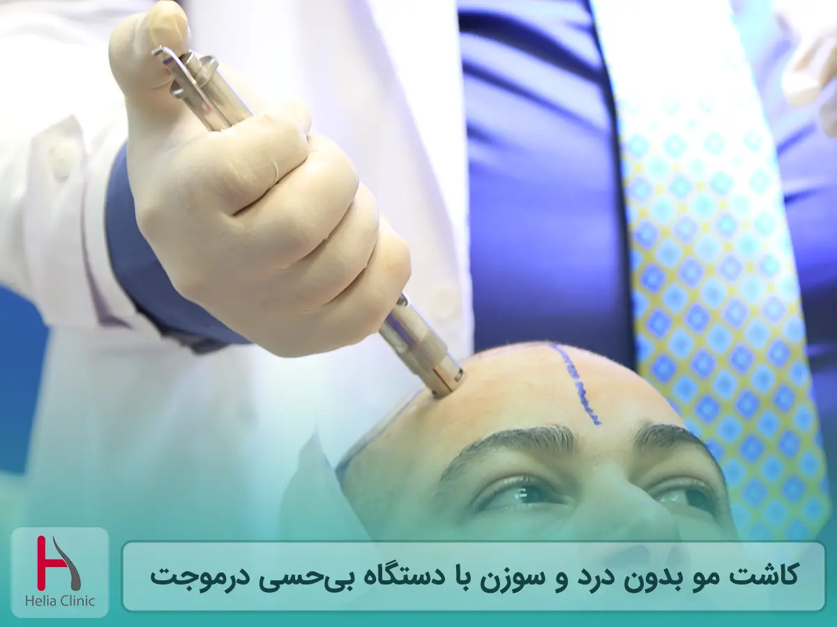 کاشت مو بدون درد و بدون سوزن (درموجت)