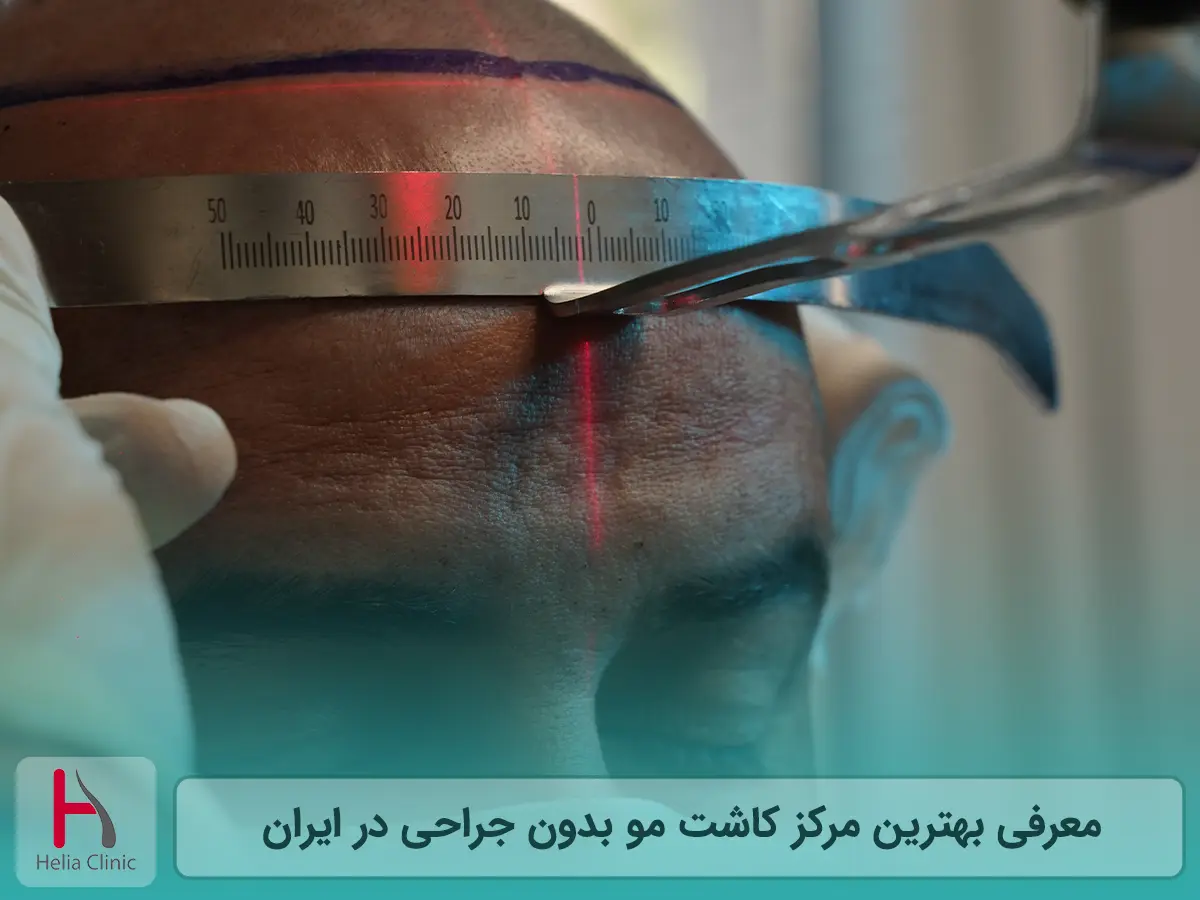 معرفی بهترین مرکز کاشت مو بدون جراحی در ایران