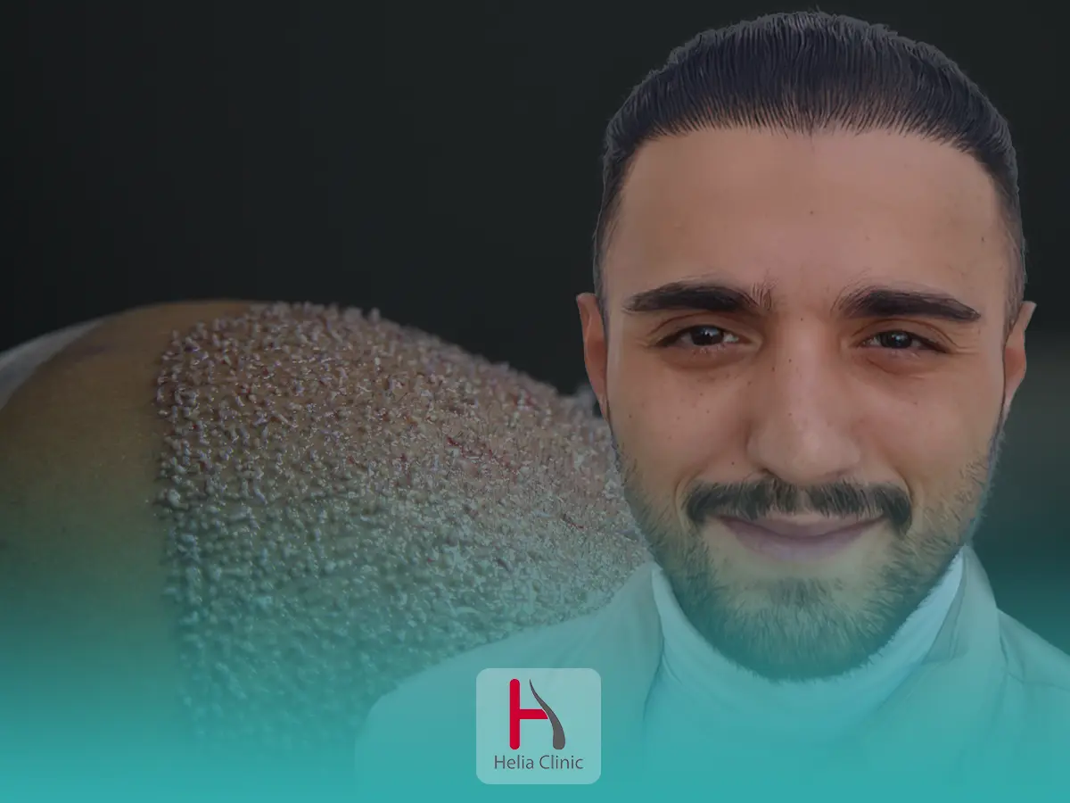 کاشت مو بدون جراحی و بدون درد و خونریزی