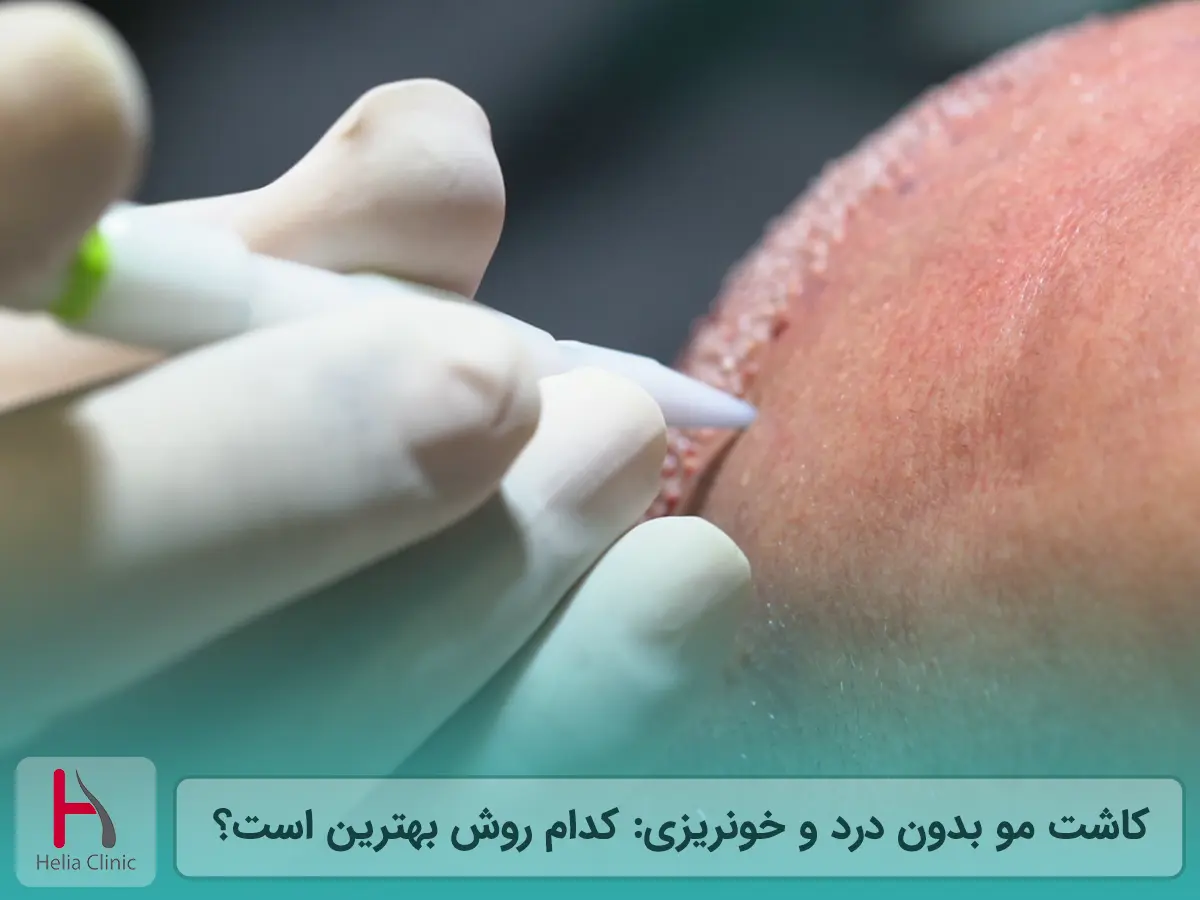 کاشت مو بدون درد و خونریزی: کدام روش بهترین است؟