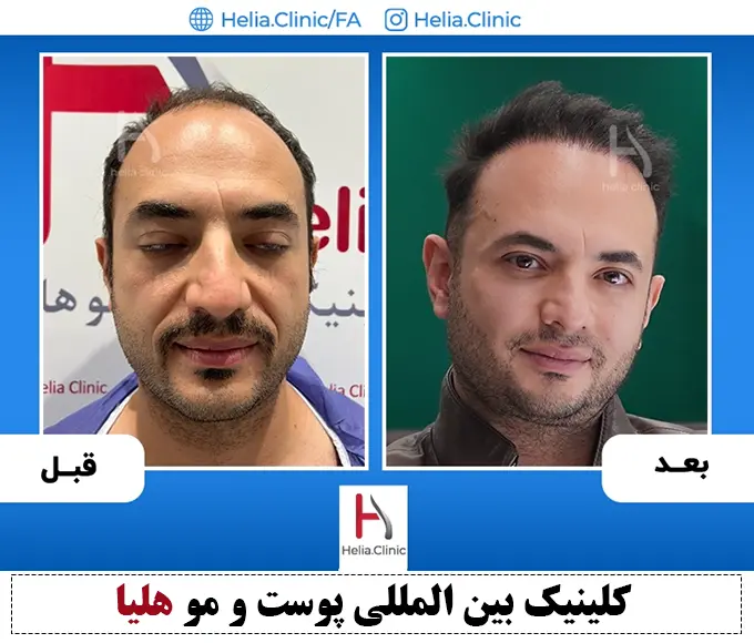 قبل و بعد کاشت مو به روش fue در کلینیک هلیا