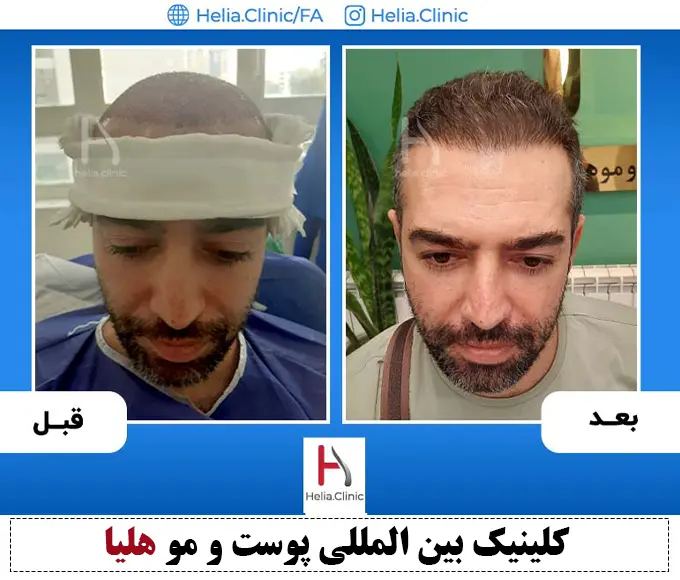 عکس پیوند مو به روش سوپر اف یو ایی