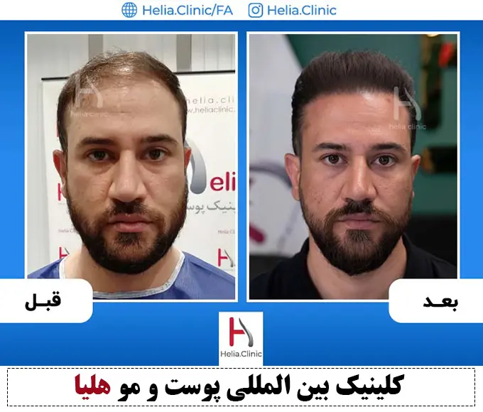 عکس کاشت مو با موهای کم پشت
