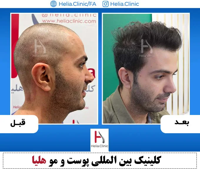 عکس کاشت مو با بانک موی ضعیف
