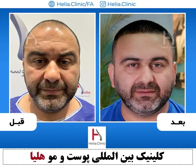 عکس کاشت مو بدون جراحی