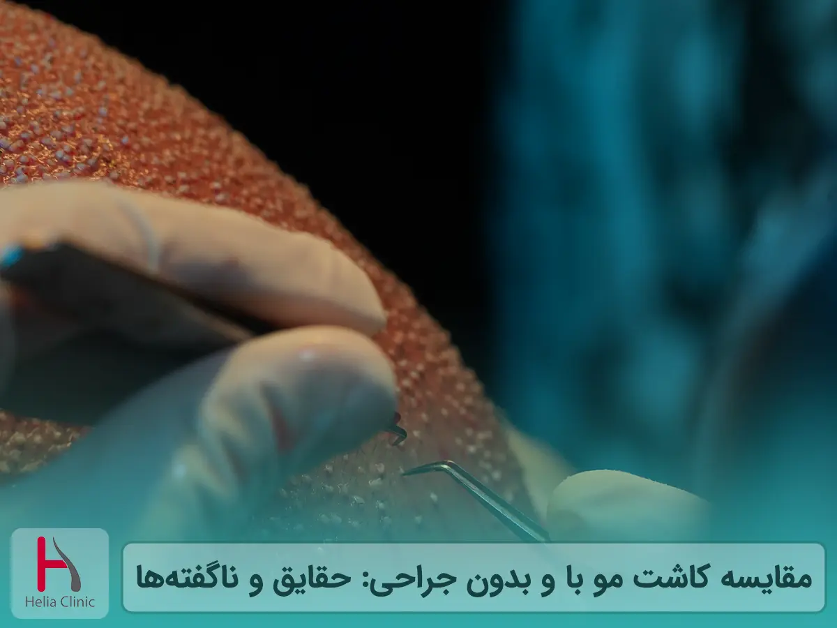 مقایسه کاشت مو با و بدون جراحی: حقایق و ناگفته‌ها