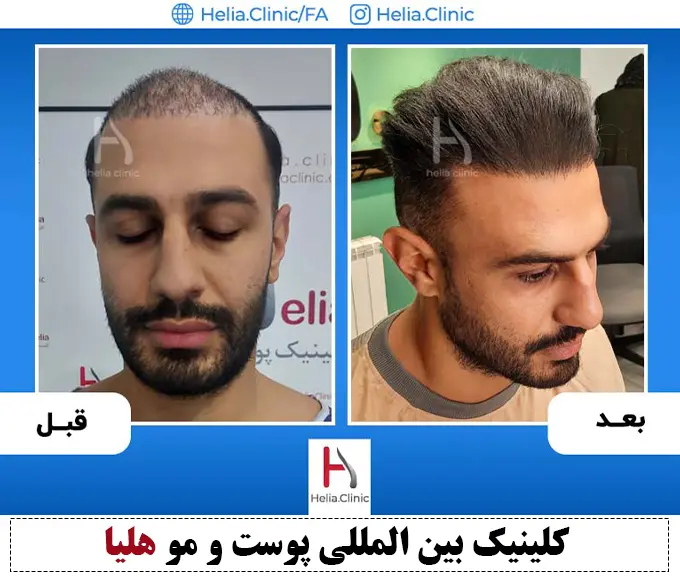 نتیجه پیوند مو با موهای کم پشت در کلینیک هلیا