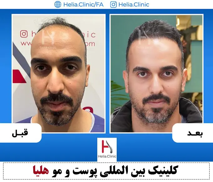 نتیحه کاشت موی طبیعی خونریزی و جراحی در کلینیک هلیا