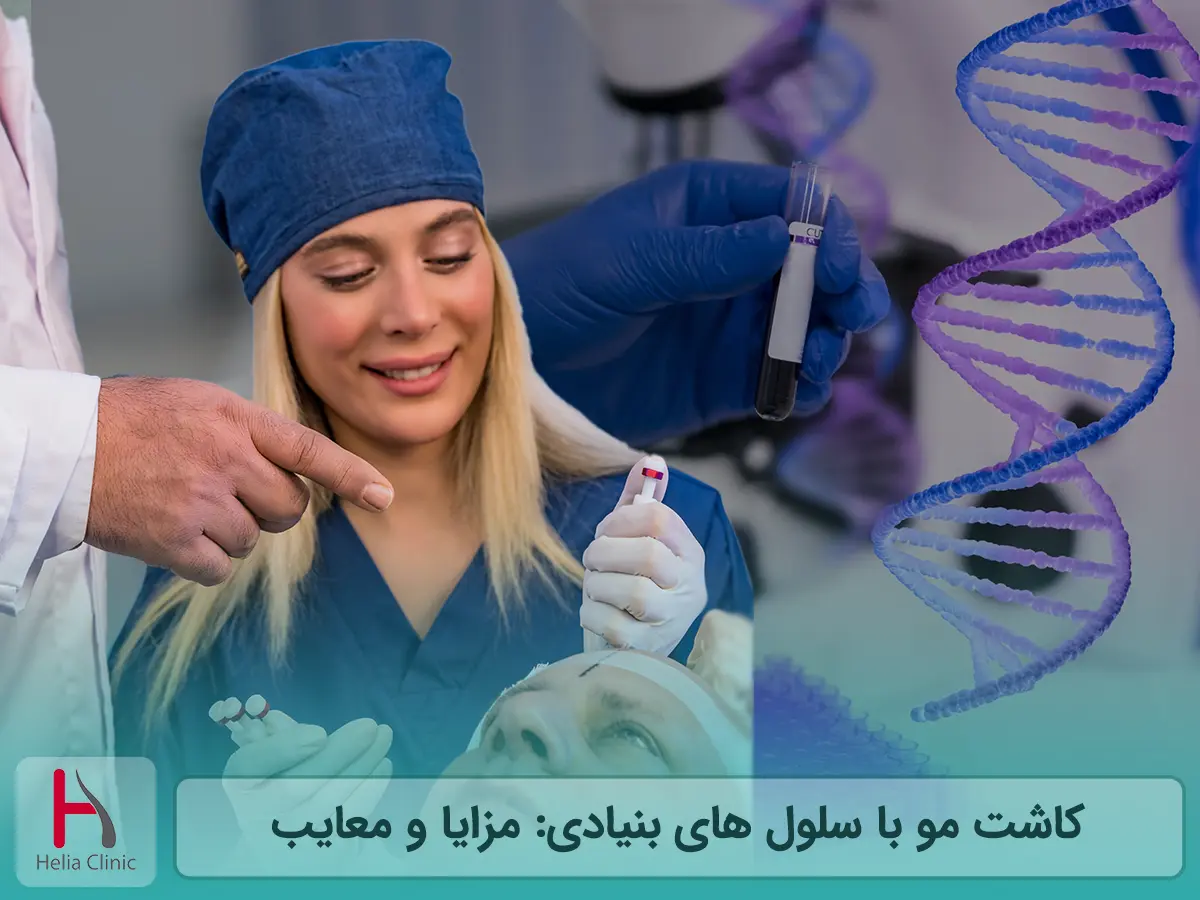کاشت مو با سلول های بنیادی: مزایا و معایب