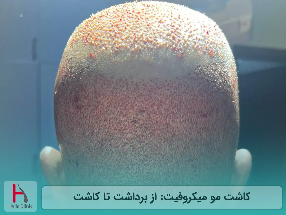 کاشت مو به روش Micro FIT: از برداشت تا کاشت