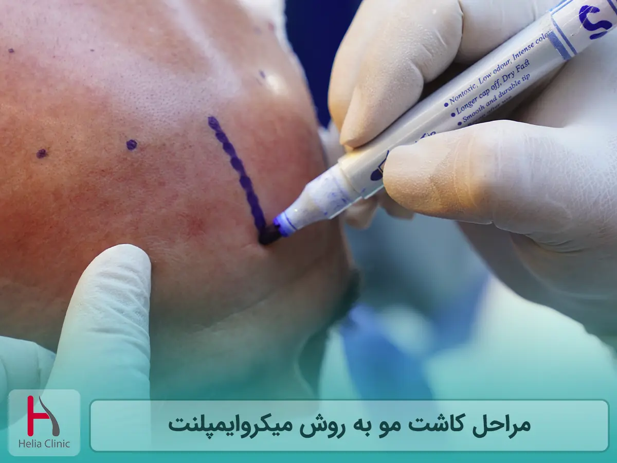 مراحل کاشت مو به روش میکروایمپلنت