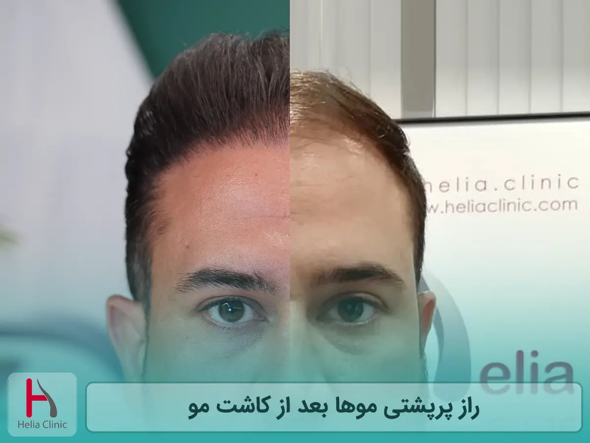 راز پرپشتی موها بعد از کاشت مو