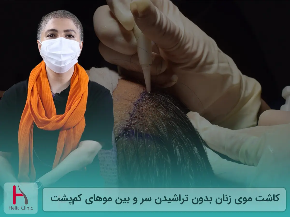 کاشت موی زنان بدون تراشیدن سر: زیبایی بدون دردسر