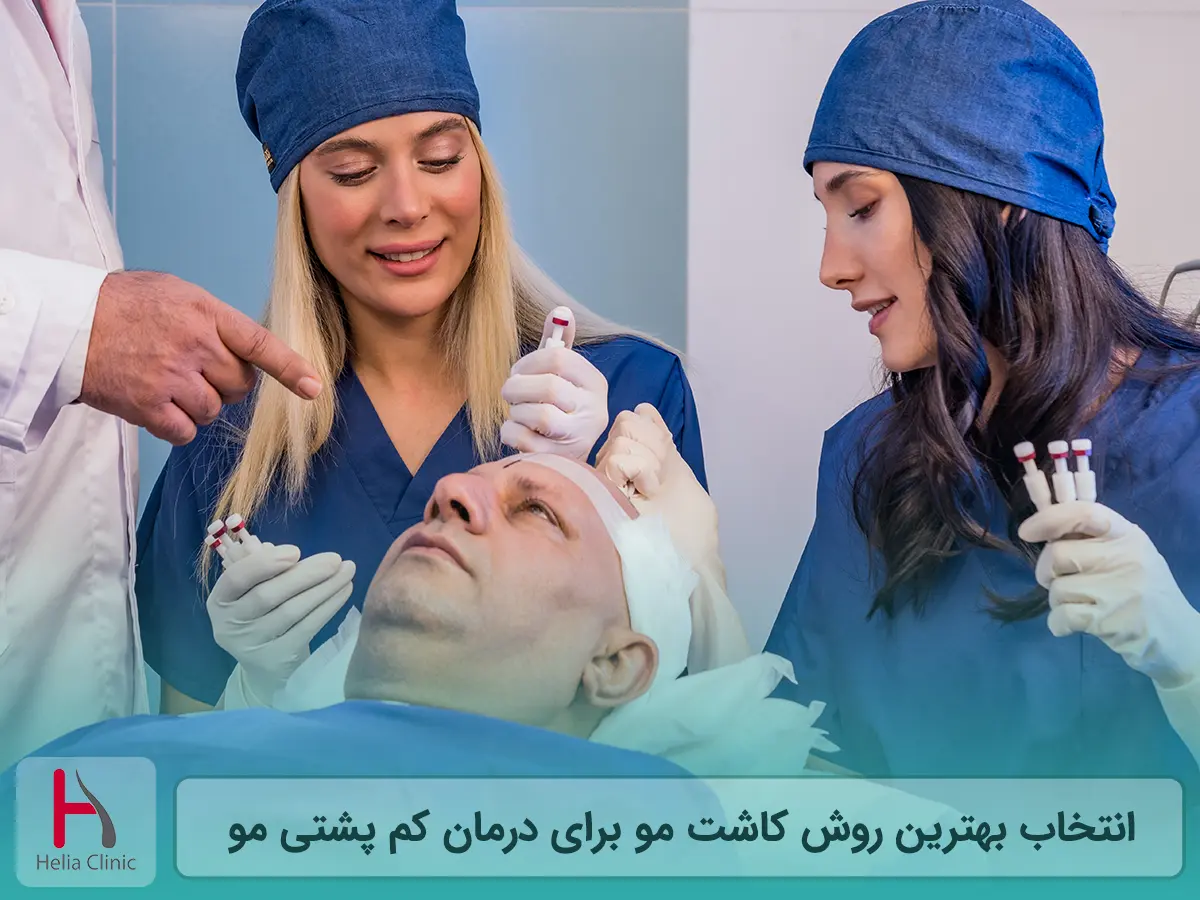 انتخاب بهترین روش کاشت مو برای درمان کم پشتی مو