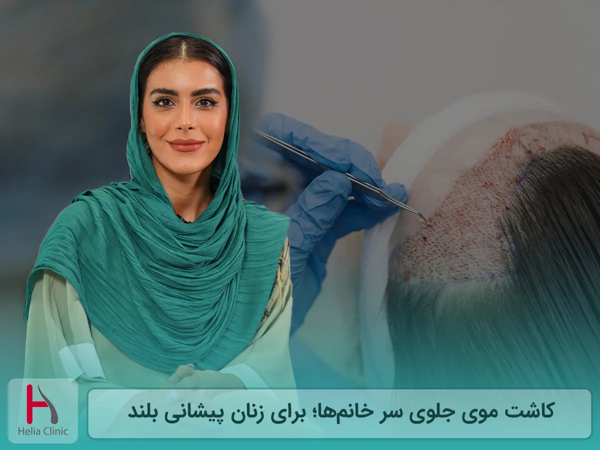 کاشت مو برای خانم ها با پیشانی بلند و تناسب چهره