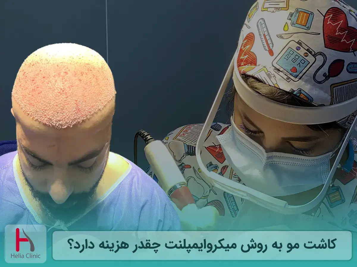 کاشت مو به روش میکروایمپلنت چقدر هزینه دارد؟