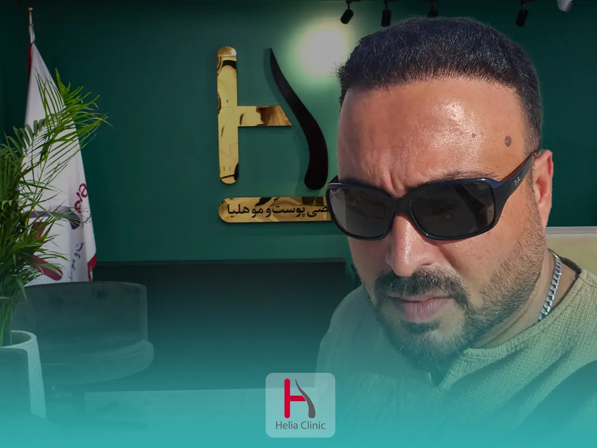 کاشت مو به روش میکروایمپلنت Micro Implant