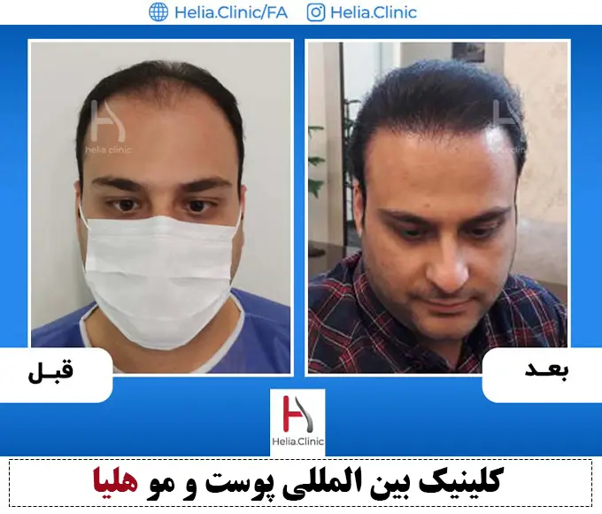 نتیجه کاشت طبیعی مو با روش اف یو ایی