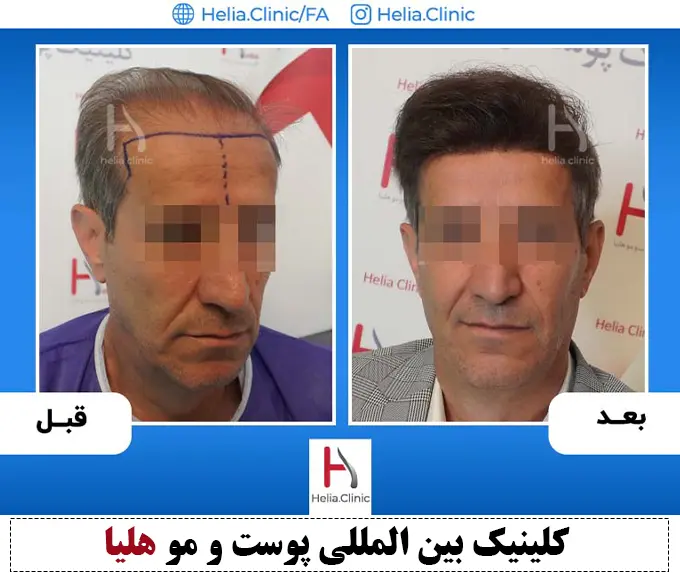 نمونه قبل و بعد کاشت موی طبیعی با موهای کم پشت