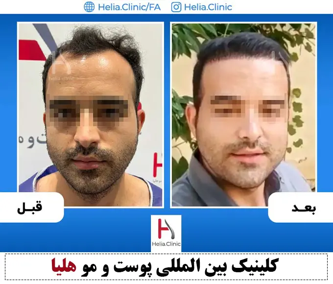 نمونه قبل و بعد پیوند مو بدون جراحی و خونریزی