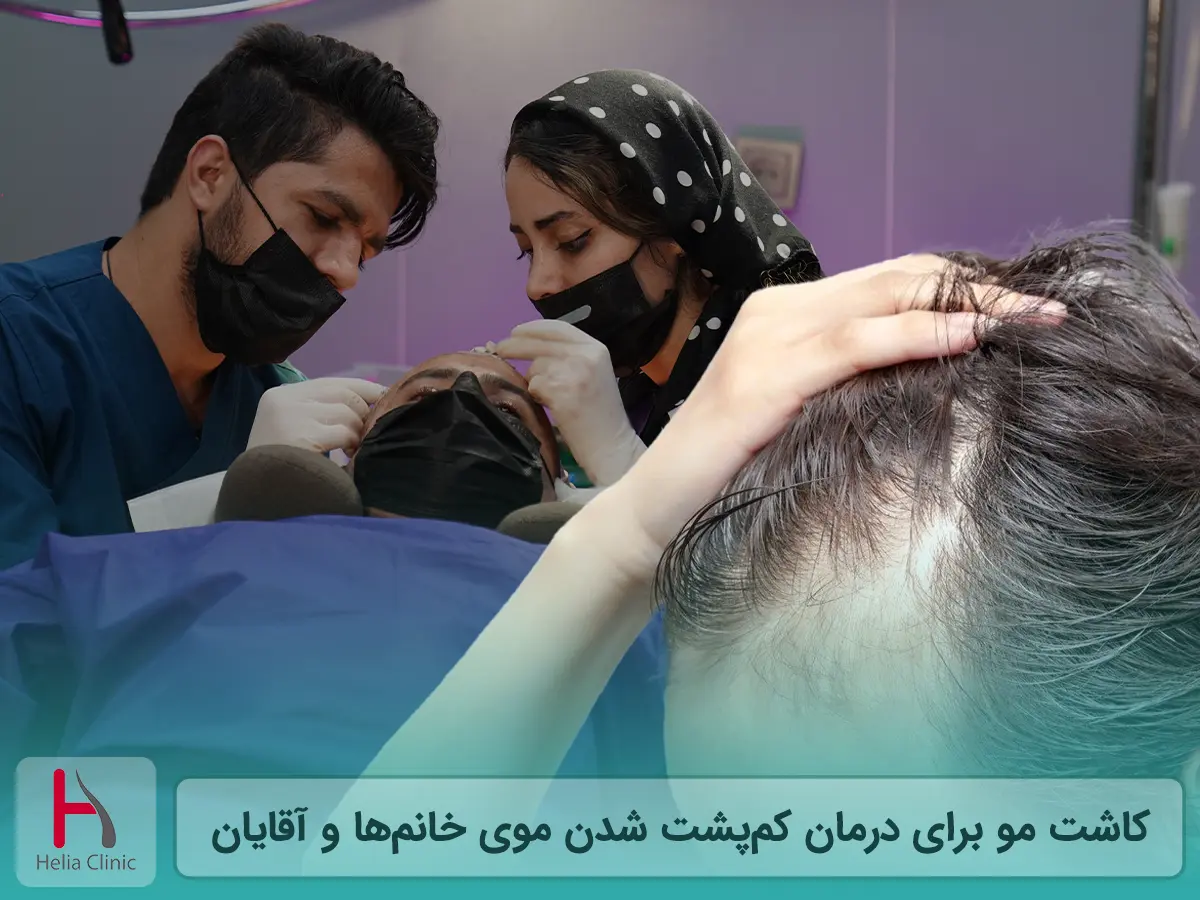 کاشت مو برای درمان کم پشت شدن موی خانم ‌ها و آقایان