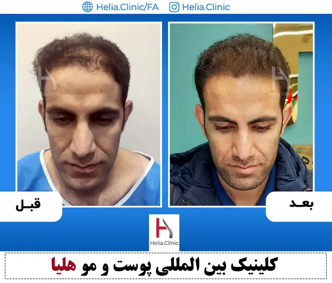 نمونه کار قبل و بعد کاشت مو در فرق سر