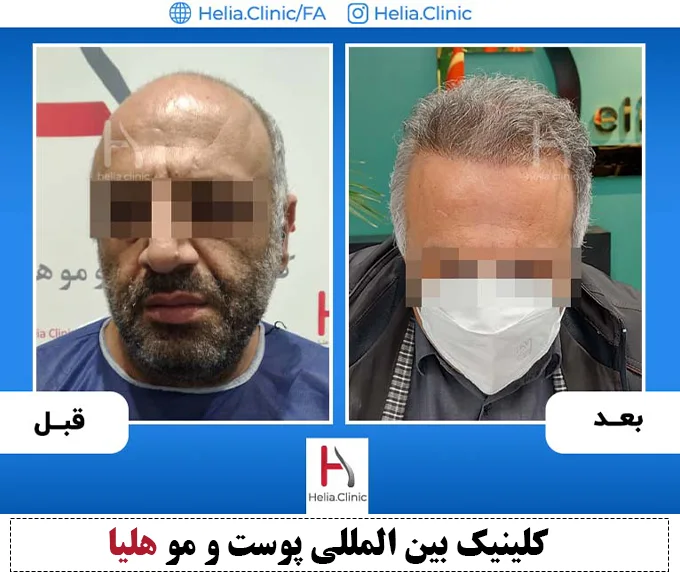 رشد موهای کاشته شده در ناحیه ورتکس