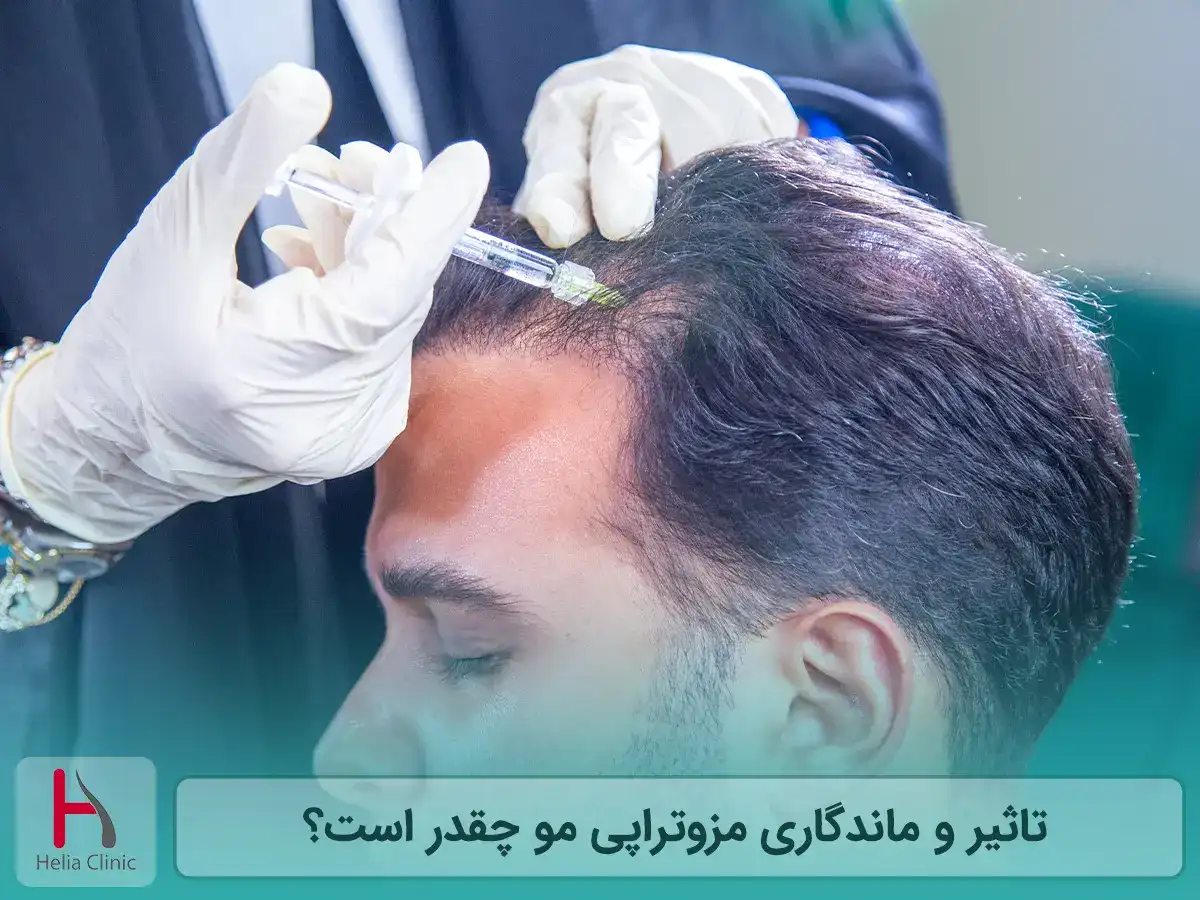تاثیر و ماندگاری مزوتراپی مو چقدر است؟