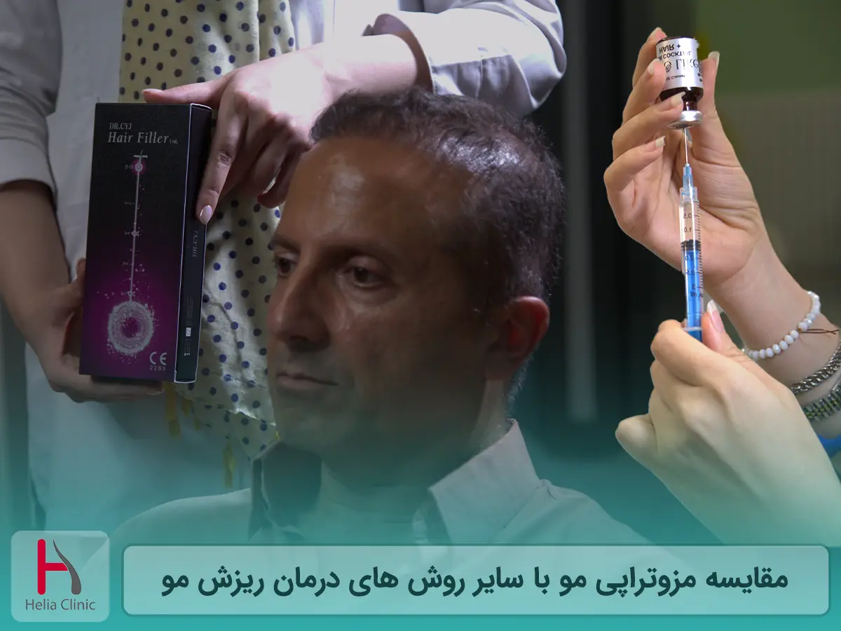 مقایسه مزوتراپی مو با سایر روش های درمان ریزش مو