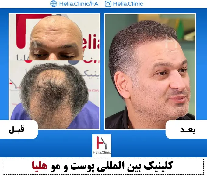 عکس کاشت مو وسط سر