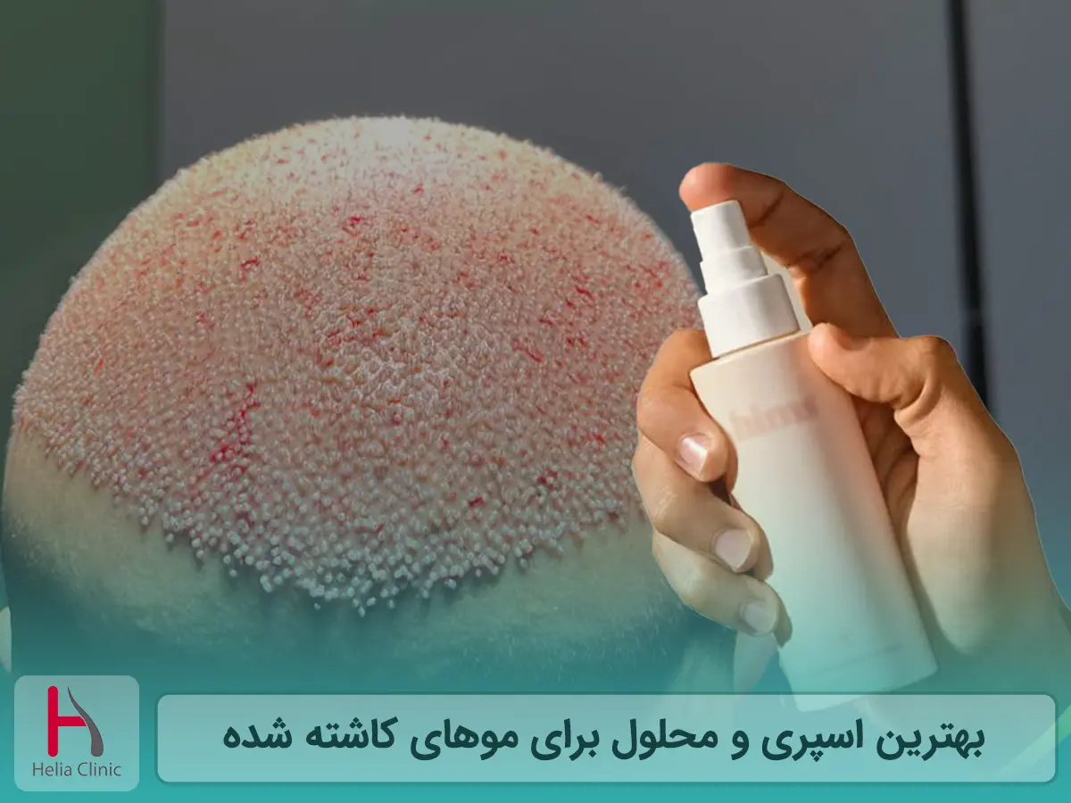 بهترین اسپری و محلول برای موهای کاشته شده