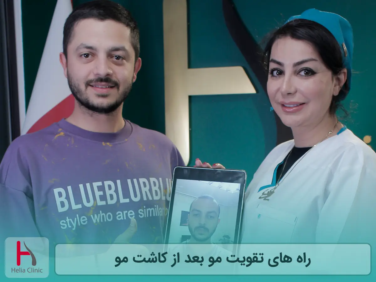 راه های تقویت مو بعد از کاشت مو