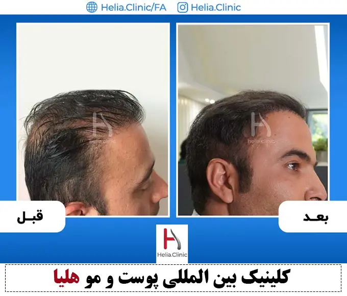 نتیجه کاشت موی طبیعی در ناحیه ورتکس