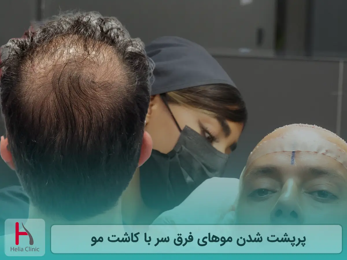پرپشت شدن موهای فرق سر با کاشت مو