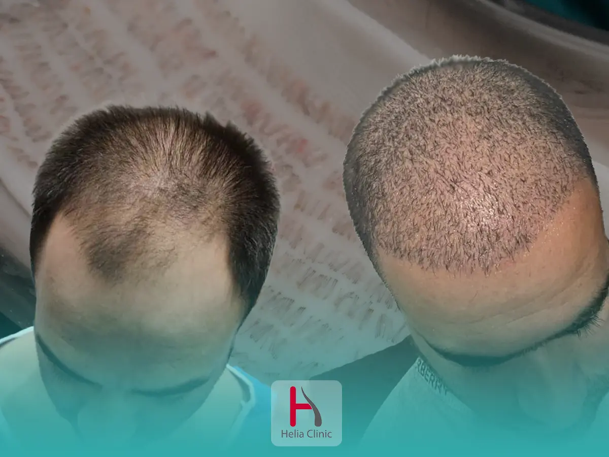 کاشت مو در ناحیه ورتکس سر در کلینیک هلیا