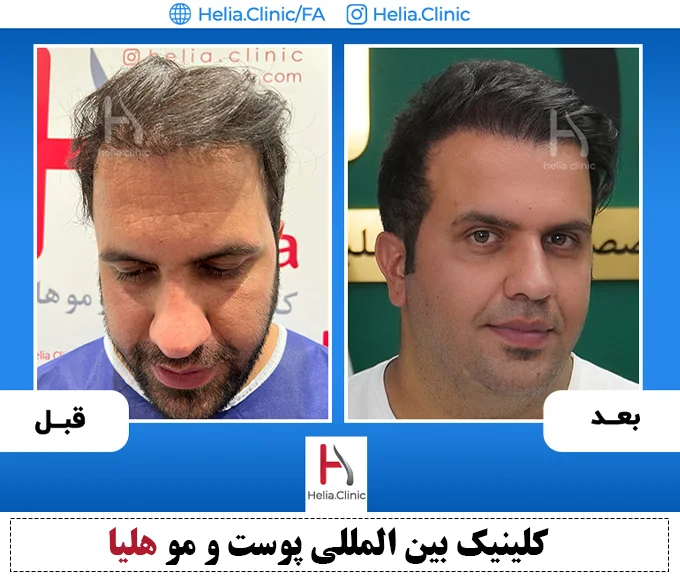 عکس قبل و بعد کاشت مو به روش fut