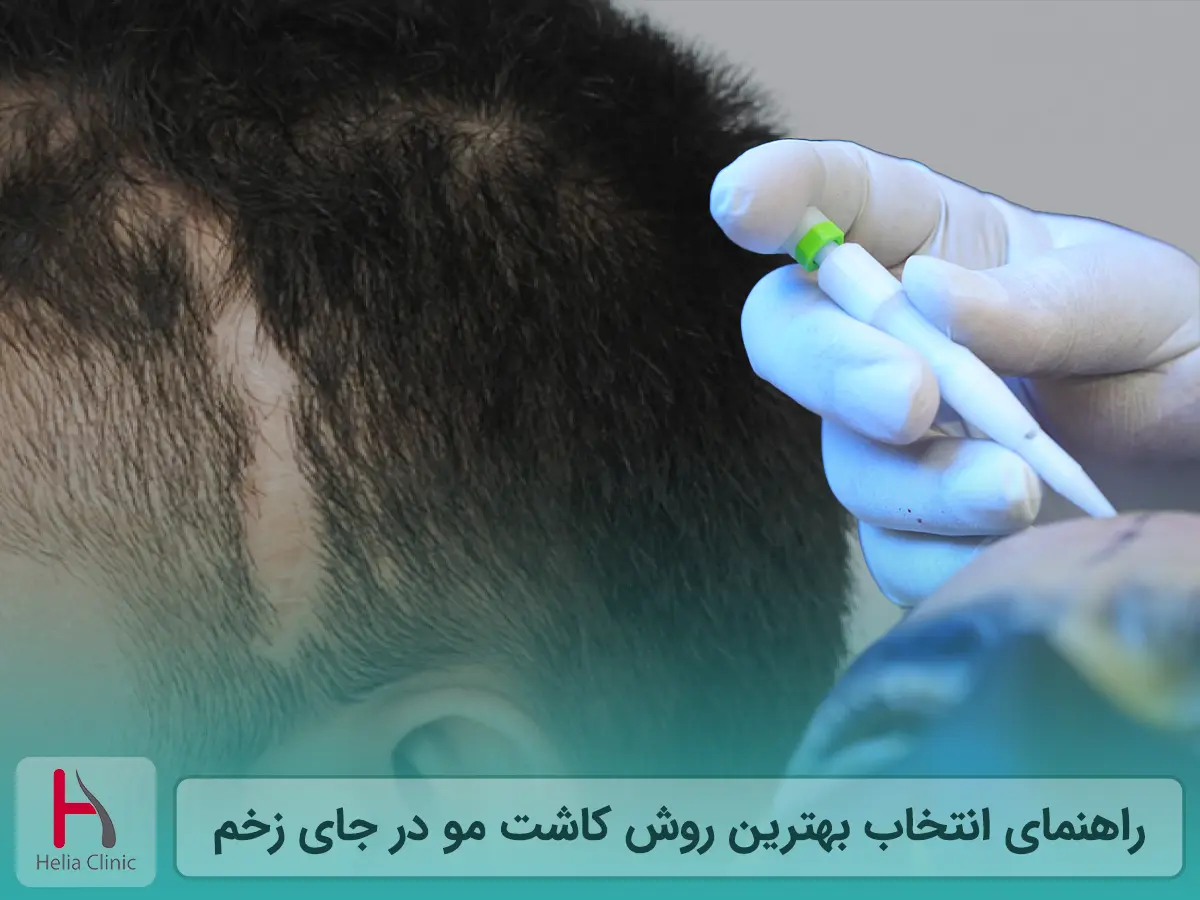 راهنمای انتخاب بهترین روش کاشت مو در جای زخم