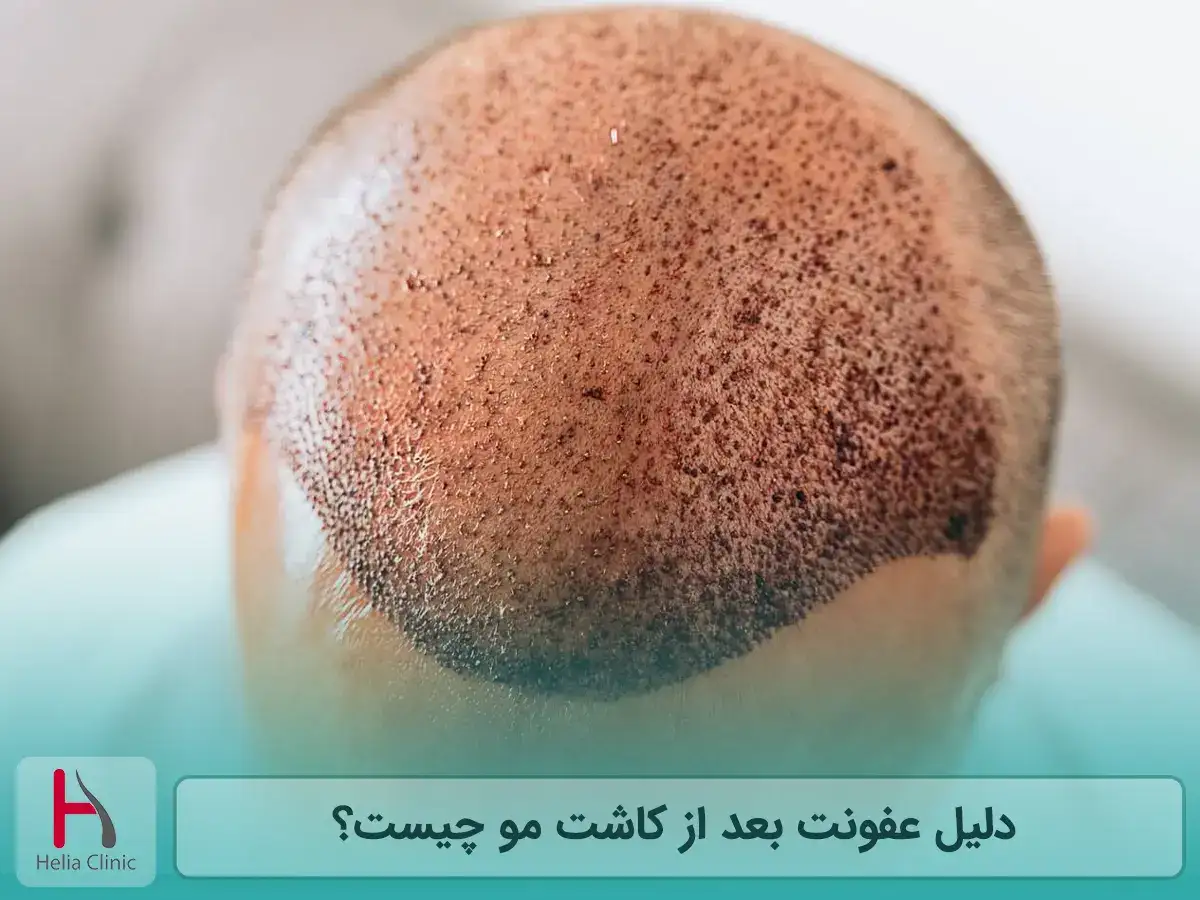 دلیل عفونت بعد از کاشت مو چیست؟