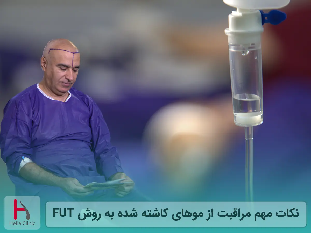 نکات مهم مراقبت از موهای کاشته شده به روش FUT