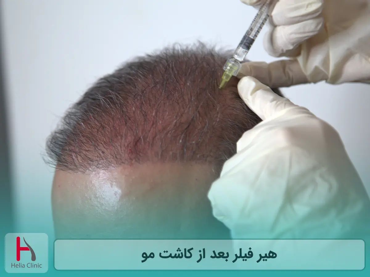 هیر فیلر بعد از کاشت مو