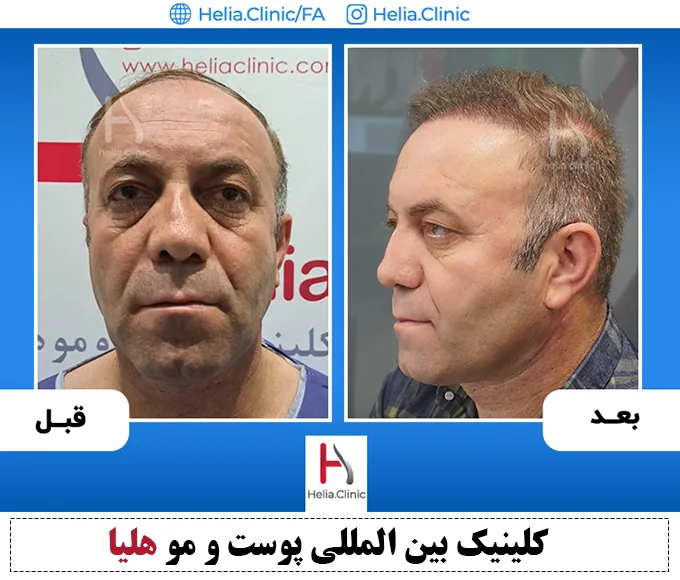 کاشت مو به روش اف یو تی در کلینیک هلیا