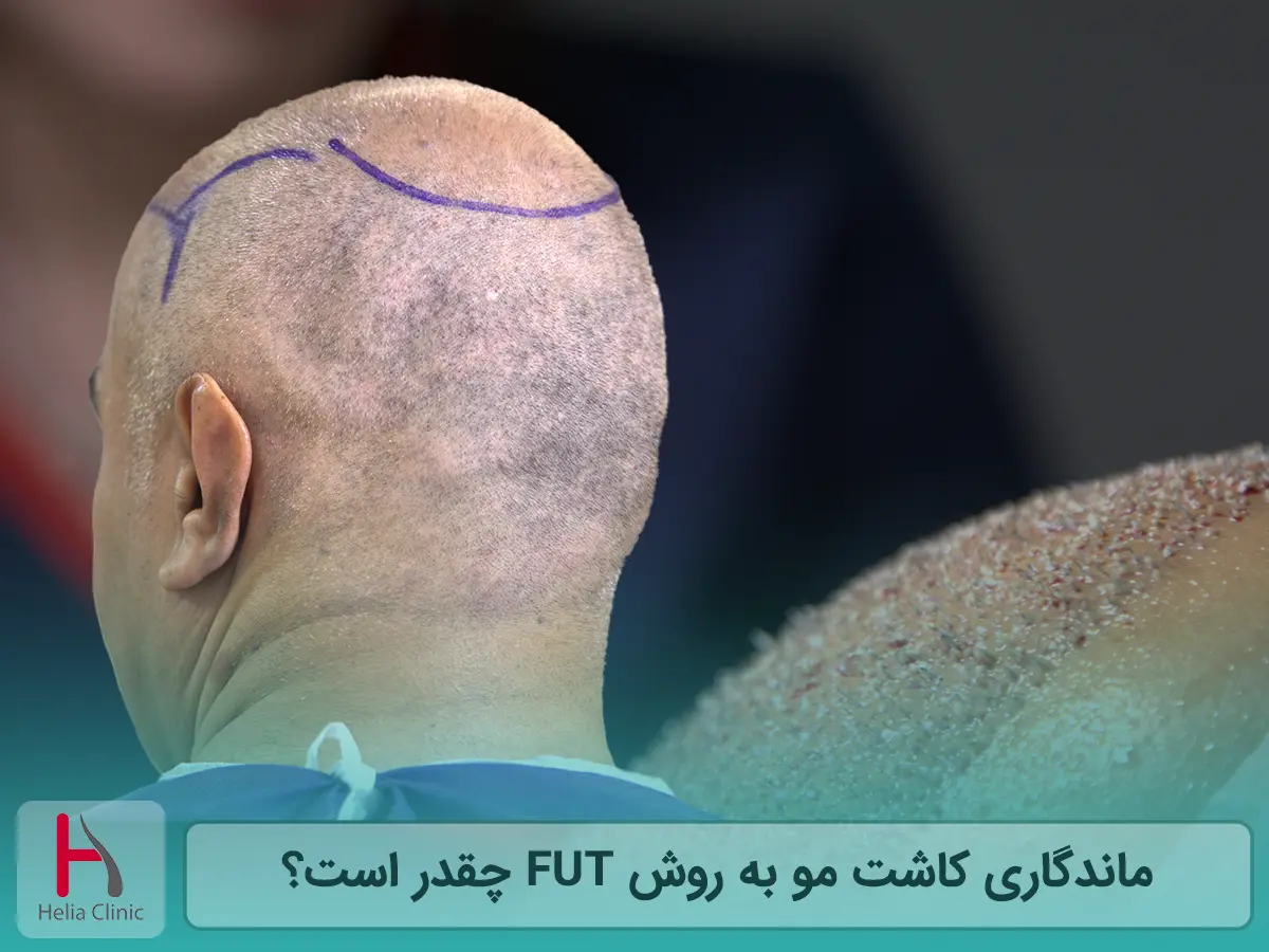 نتیجه و ماندگاری کاشت مو به روش FUT