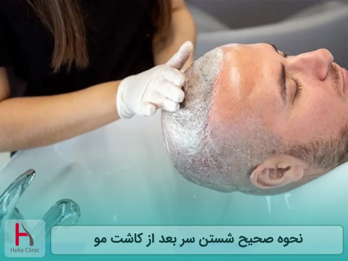 نحوه صحیح شستن سر بعد از کاشت مو